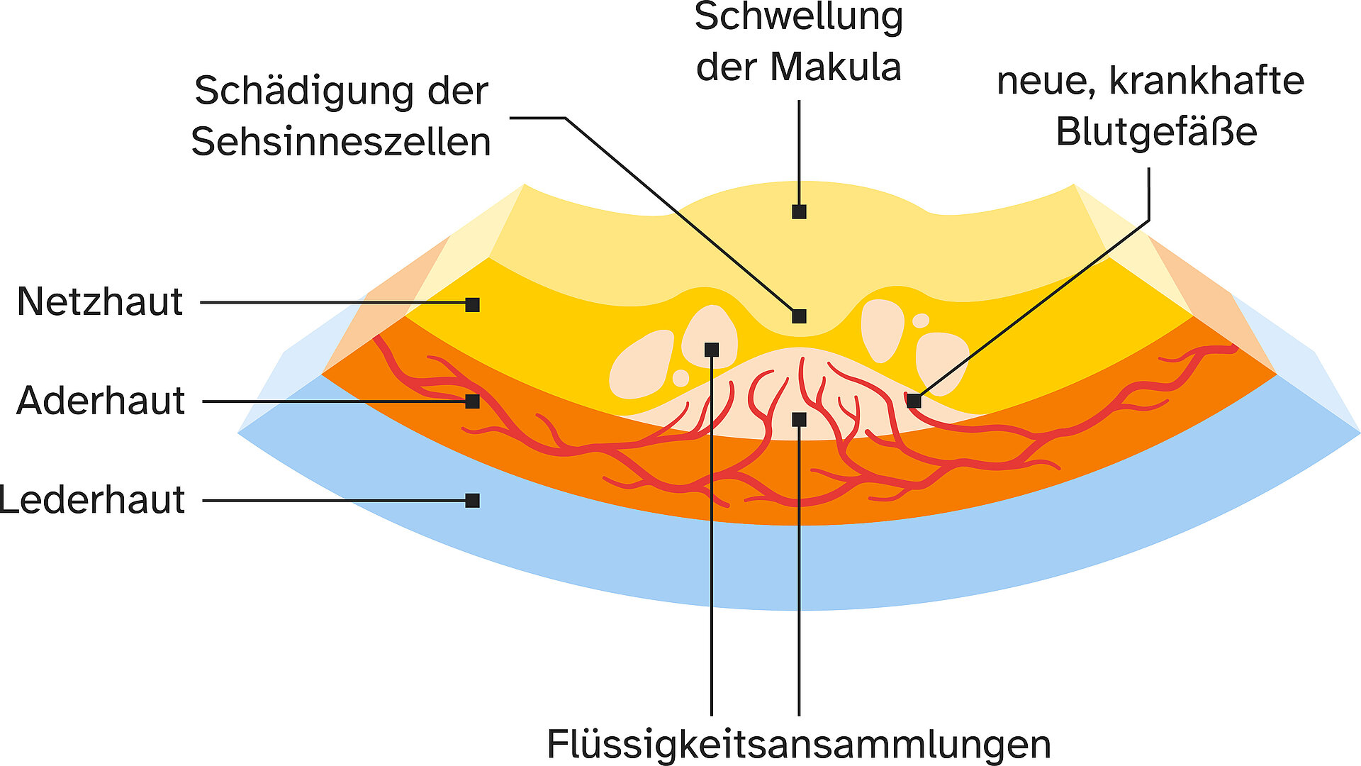 Infografik feuchte AMD Neu gebildete Gefäße können in die Netzhaut einwachsen.